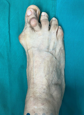 Evaluación médica de pie — juanete
